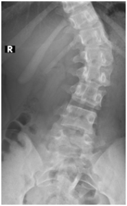 Spinal scoliosis x-ray