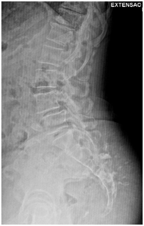 An x-ray of spondylolisthesis