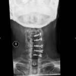 An x-ray of a cervical spine with titanium mini plates and screws