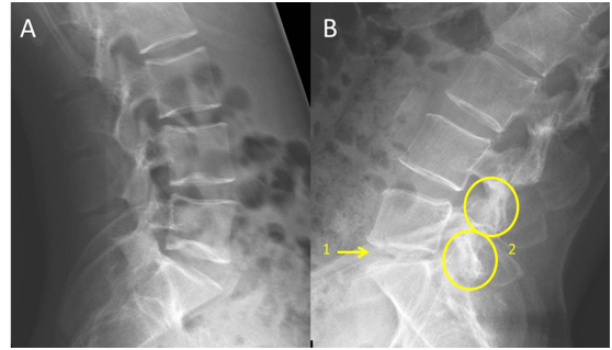 Picture A and B. Picture A is an X-ray of a relatively normal lumbar spine. Picture B shows the spine degenerative changes such as disc space narrowing and facet joint hypertrophy