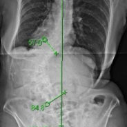 An x-ray of a spine with degenerative scoliosis