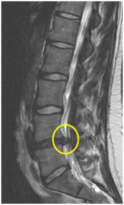 MRI of a degenerate spinal disc that is protruding into the spinal canal and pressing on the spinal nerves