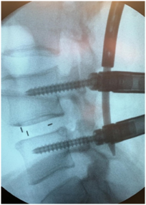keyhole spine surgery with rods and screws