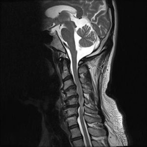 An MRI scan of swelling spinal cord