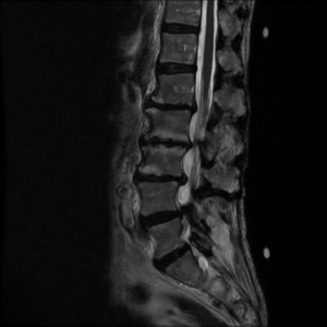 An MRI scan of a spine with degenerative scoliosis