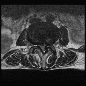 An MRI scan of low back (lumbar) spinal disc with degenerative scoliosis