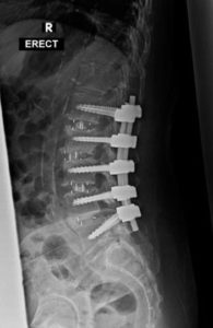 An x-ray of spinal fusion surgery where is done by going through the side