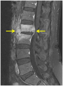 MRI scan of a spinal infection