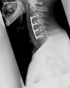 An x-ray of a cervical spine with anterior cervical discectomy and fusion surgery