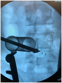 lumbar spinal fusion surgery using the keyhole method