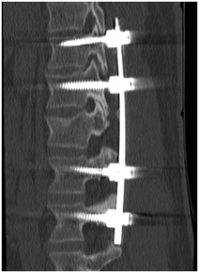 CT scan of a post-surgical spine with metal implants