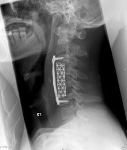 An x-ray of a cervical spine with anterior corpectomy and fusion surgery