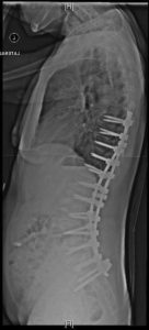 An x-ray on a side view of the spine with long fusion surgery