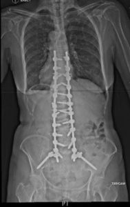 An x-ray on a back view of the spine with long fusion surgery