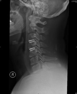 An x-ray of a cervical spine with artificial disc implants