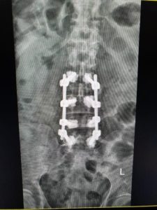 An x-ray of eight titanium screws was inserted above and below the fractured vertebra