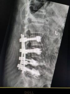 An x-ray of eight titanium screws was inserted above and below the fractured vertebra