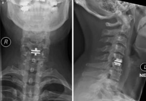 An x-ray of a cervical spine conducting a hybrid procedure