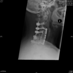 An x-ray of a cervical spine with posterior and anterior approaches surgery