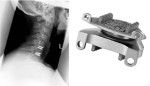 Artificial Disc Replacement - Neck Pain Treatment