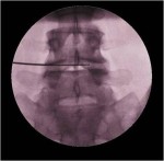 Minimally invasive spine surgery Nucleoplasty