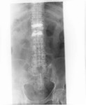 Minimally invasive spine surgery kyphoplasty