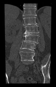 An x-ray of degenerative scoliosis located in the low back or lumbar spine