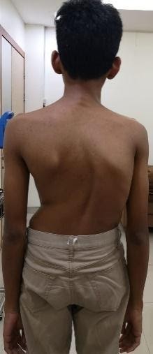 A back view of a boy with curved spinal and uneven shoulder, which are the symptoms of adolescent idiopathic scoliosis