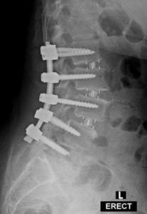 An x-ray of five titanium screws placed on the vertebrae
