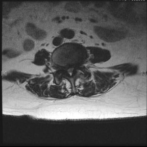 An MRI scan on the low back (lumbar) spinal nerve