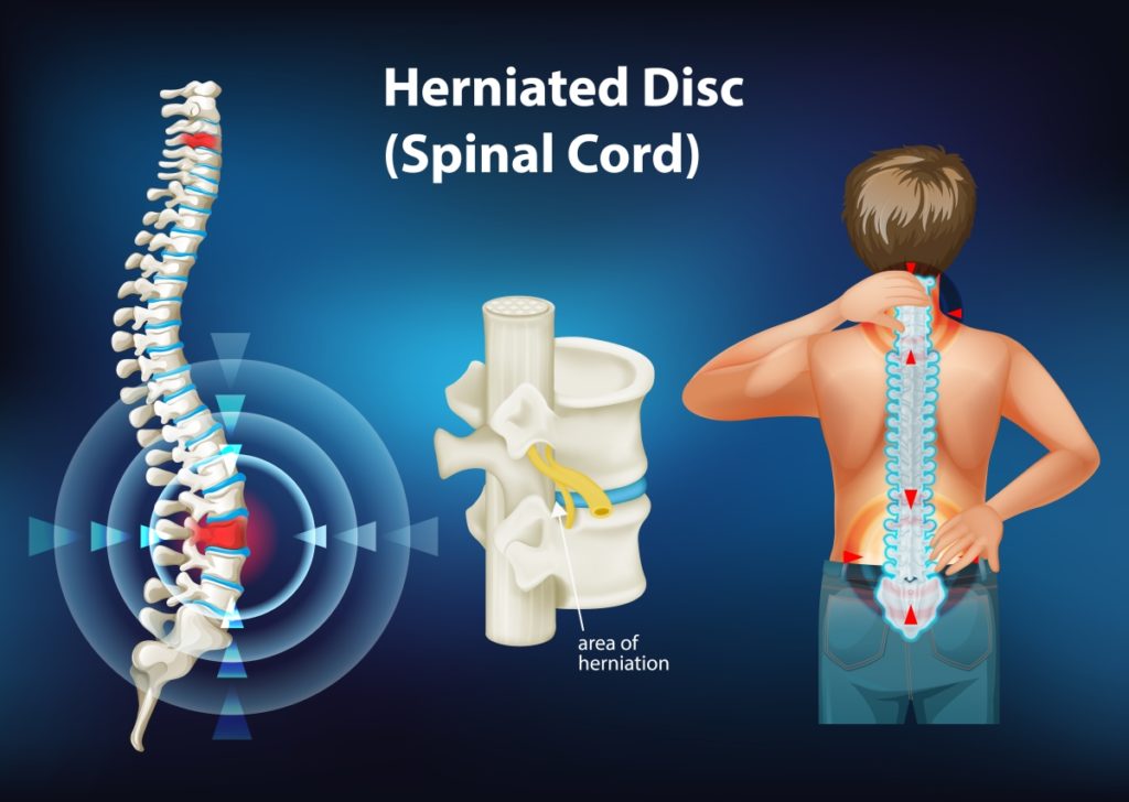 Herniated disc in spinal cord description