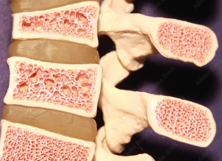 osteoporosis of the spine