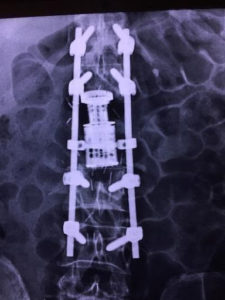 An x-ray of traditional open surgery for spinal tumor using titanium screws and rods, viewed from the back