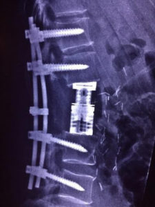 An x-ray of traditional open surgery for spinal tumor using titanium screws and rods, viewed from the side