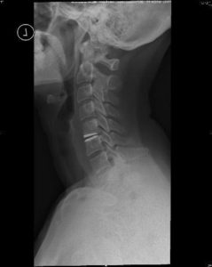 An x-ray of a cervical disc replacement