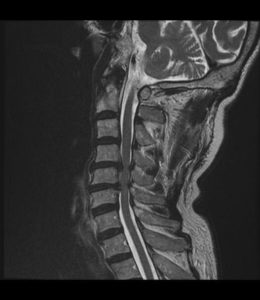 An x-ray of prolapsed discs