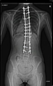 An x-ray of an after spinal fusion surgery back view