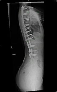 An x-ray of an after spinal fusion surgery side view