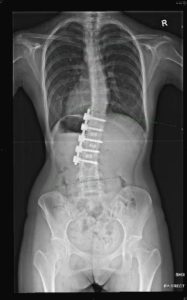 An x-ray of a single lumbar spine curve after surgery