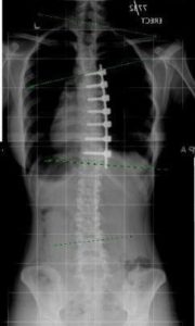An x-ray of a single thoracic spine curve after surgery