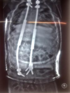 An x-ray of a non-fusion surgery using growing rods