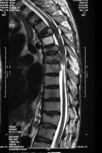 An MRI scan of spinal metastasis