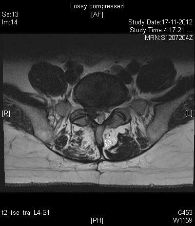 MRI scan of low back (lumbar) spine