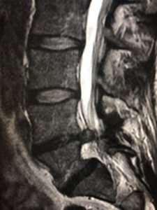 a right-sided prolapsed disc on a cross-sectional MRI view of the low back