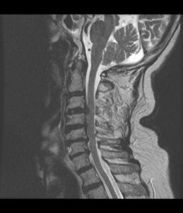 MRI scan of the Cervical Spine