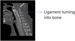 The position of the posterior longitudinal ligament