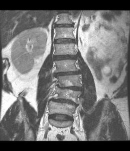 An x-ray of a spinal misalignment viewed from the back