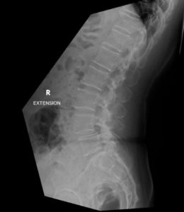 An x-ray of a forward slip of the vertebra viewed from the side