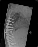 spine deformity surgery