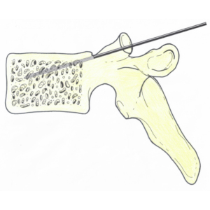 Vertebroplasty surgical procedure which uses the minimally invasive percutaneous technique